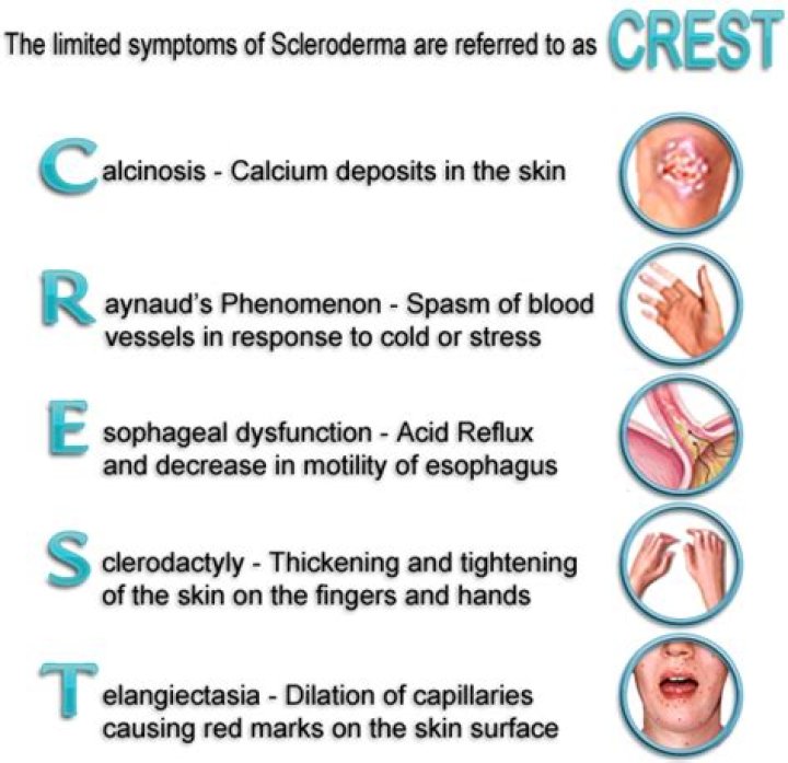 What is CREST Syndrome and Scleroderma? Understanding These Conditions