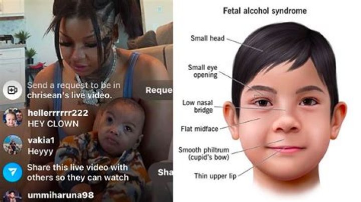 What Syndrome Does Chrisean's Baby Have? Unpacking Public Interest and Private Health