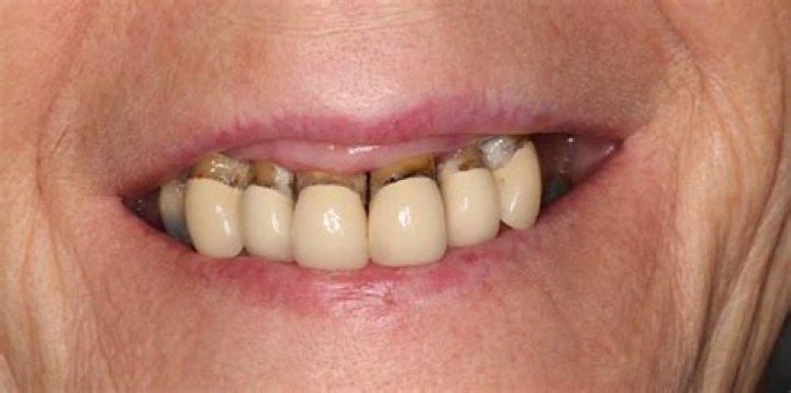 Who Wears Dentures in Hollywood? Uncovering the Real Smiles